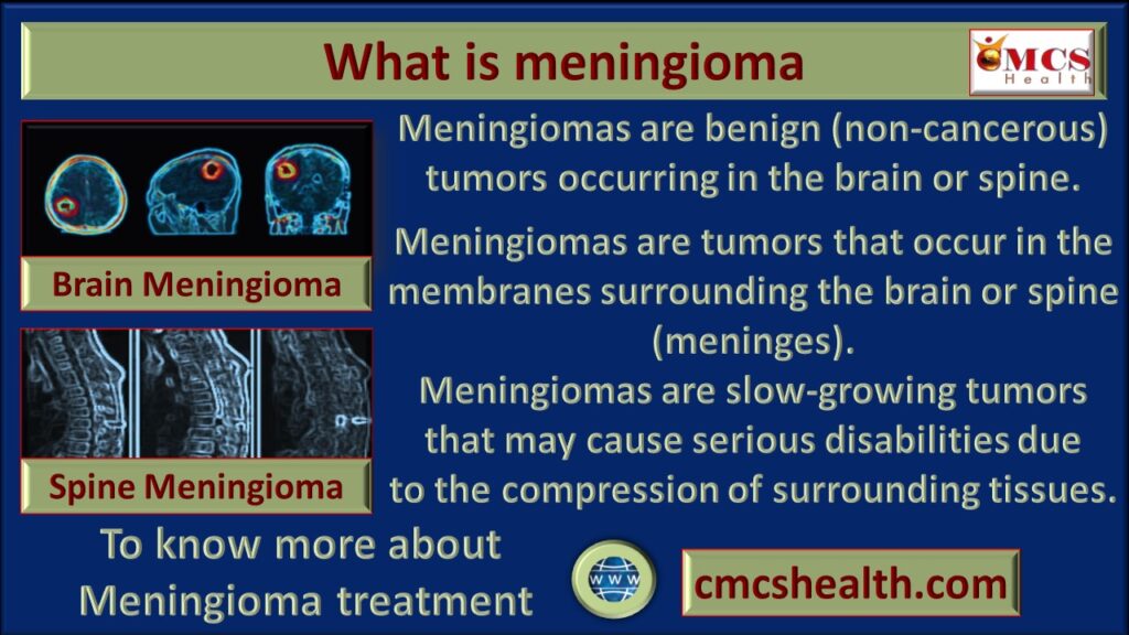 Meningioma - Best meningioma hospitals in India..