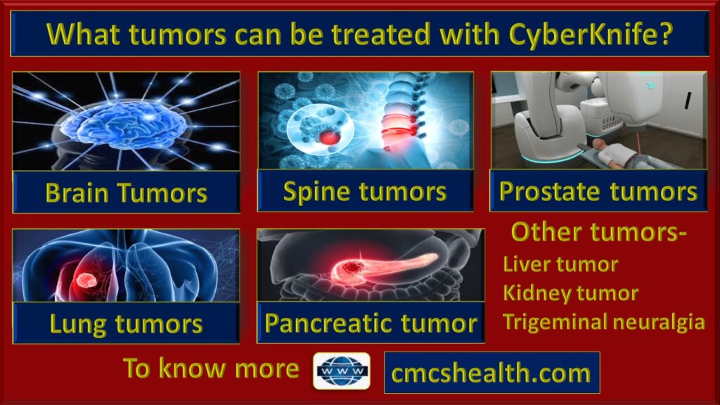Inoperable and surgically complex Tumors treated with CyberKnife-CMCS Health.